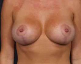 Breast Mastopexy Before & After Patient #136