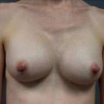 Breast Augmentation Before & After Patient #885