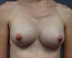 Breast Augmentation Before & After Patient #885
