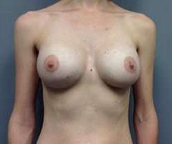 Breast Augmentation Before & After Patient #892