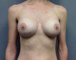 Breast Augmentation Before & After Patient #892