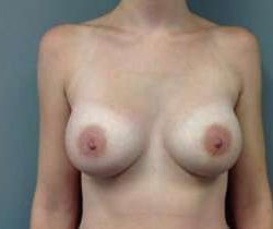 Breast Augmentation Before & After Patient #899