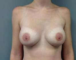 Breast Augmentation Before & After Patient #899