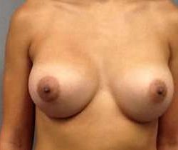 Breast Augmentation Before & After Patient #911