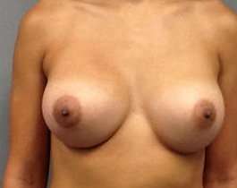 Breast Augmentation Before & After Patient #911