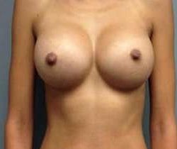 Breast Augmentation Before & After Patient #918