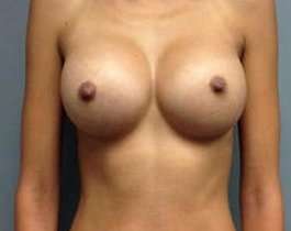 Breast Augmentation Before & After Patient #918