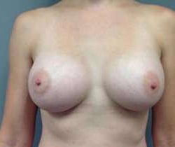 Breast Augmentation Before & After Patient #925