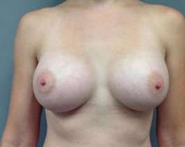 Breast Augmentation Before & After Patient #925