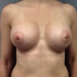 Breast Augmentation Before & After Patient #932