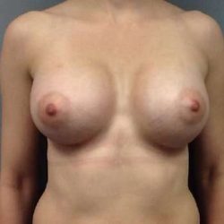 Breast Augmentation Before & After Patient #932