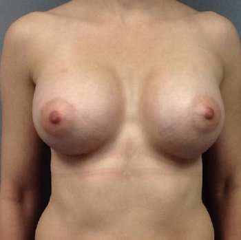 Breast Augmentation Before & After Patient #932