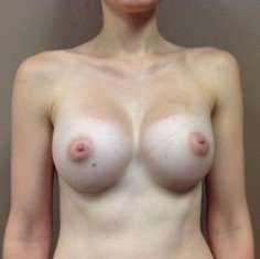 Breast Augmentation Before & After Patient #945