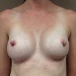 Breast Augmentation Before & After Patient #971