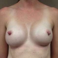 Breast Augmentation Before & After Patient #971