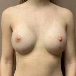 Breast Augmentation Before & After Patient #1015