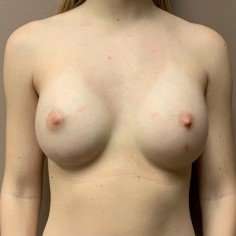 Breast Augmentation Before & After Patient #1015