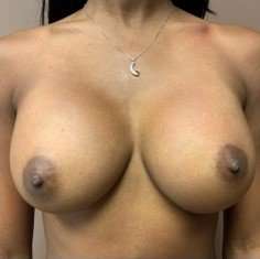 Breast Augmentation Before & After Patient #1039