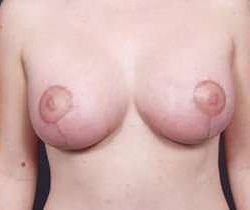 Breast Mastopexy Before & After Patient #155