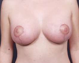Breast Mastopexy Before & After Patient #155