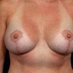 Breast Mastopexy Before & After Patient #162
