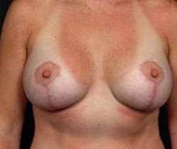 Breast Mastopexy Before & After Patient #162