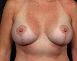 Breast Mastopexy Before & After Patient #162