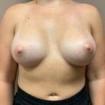 Breast Augmentation Before & After Patient #1128