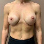 Breast Augmentation Before & After Patient #1162