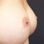 Breast Miscellaneous Before & After Patient #75