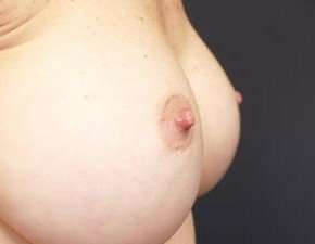 Breast Miscellaneous Before & After Patient #75