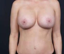 Breast Mastopexy Before & After Patient #169