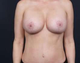 Breast Mastopexy Before & After Patient #169