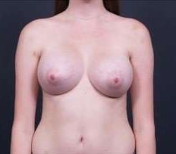 Breast Asymmetry Before & After Patient #1215