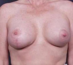 Breast Asymmetry Before & After Patient #1220