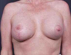 Breast Asymmetry Before & After Patient #1220