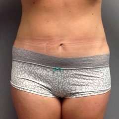 Tummy Tuck Before & After Patient #1228