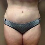 Tummy Tuck Before & After Patient #1233