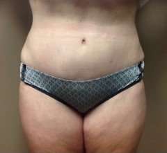 Tummy Tuck Before & After Patient #1233