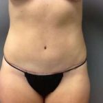 Tummy Tuck Before & After Patient #1238