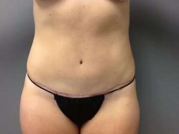 Tummy Tuck Before & After Patient #1238