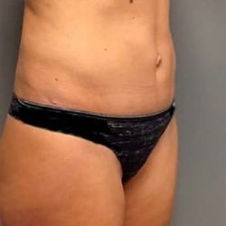 Tummy Tuck Before & After Patient #1243