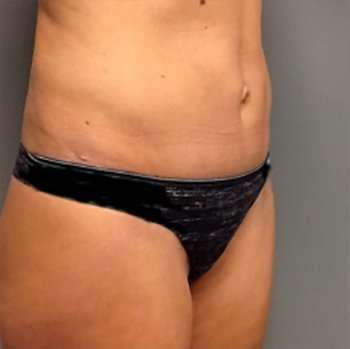 Tummy Tuck Before & After Patient #1243