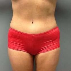 Tummy Tuck Before & After Patient #1246