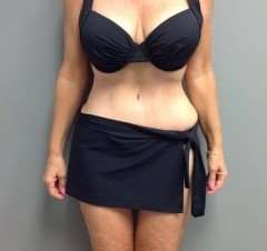 Tummy Tuck Before & After Patient #1251