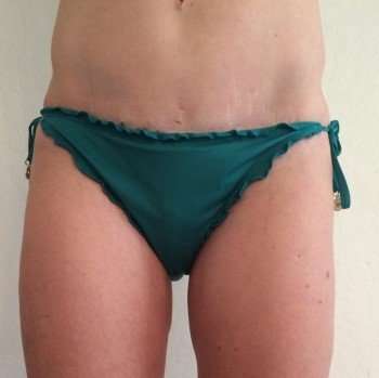 Tummy Tuck Before & After Patient #1256