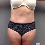 Tummy Tuck Before & After Patient #1263