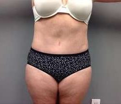 Tummy Tuck Before & After Patient #1263