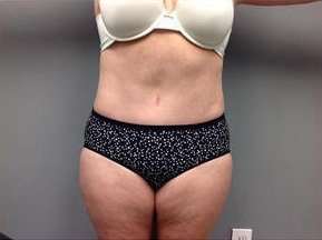 Tummy Tuck Before & After Patient #1263