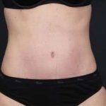 Tummy Tuck Before & After Patient #1270